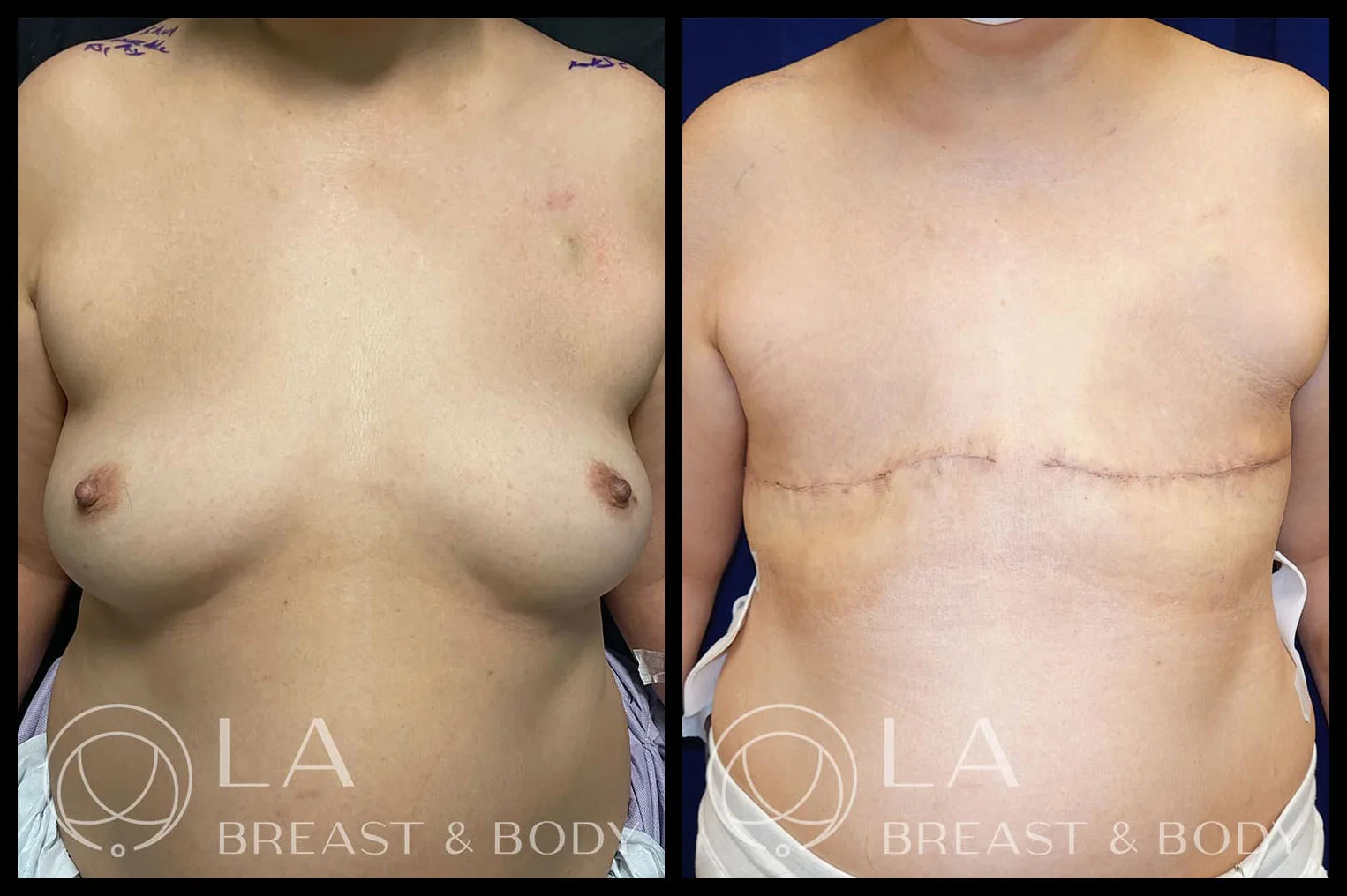 Aesthetic flat closure — before and after