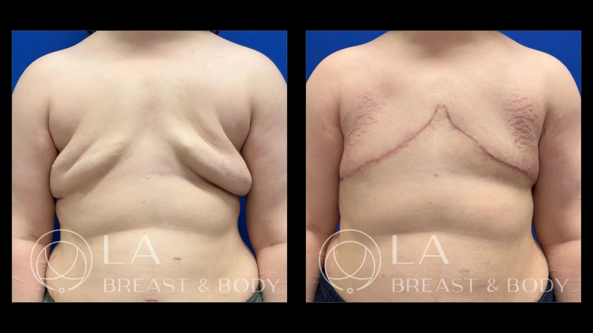 Aesthetic flat closure revision — before and after, front view