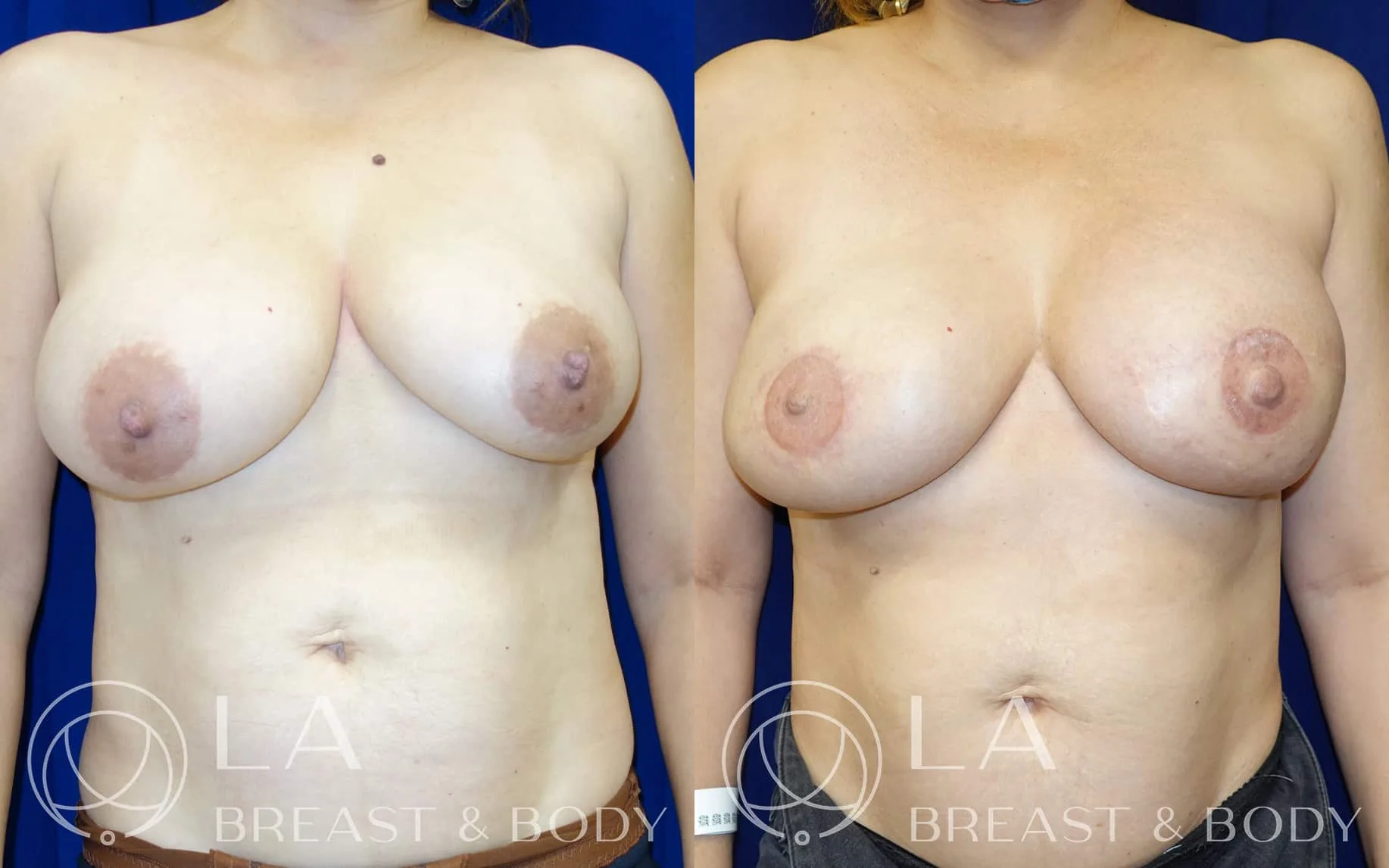 Bra-line back lift latissimus flap — before and after reconstruction