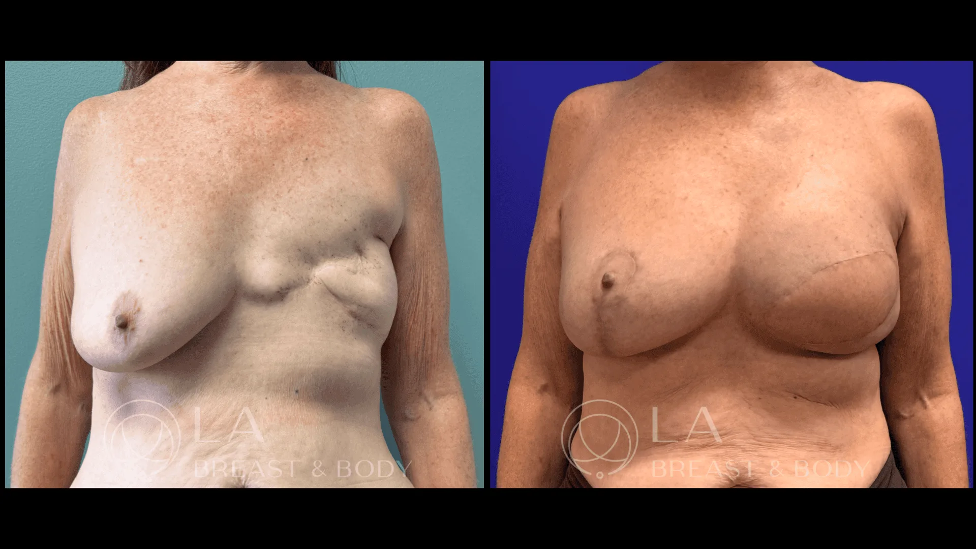 Delayed latissimus flap reconstruction — before and after, front view