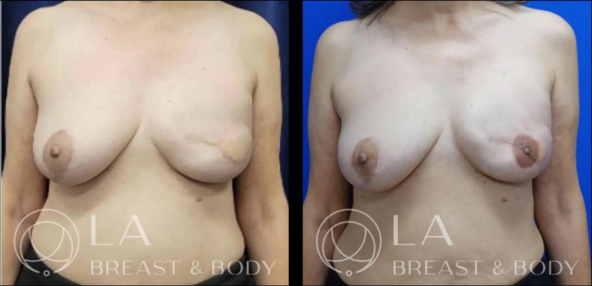Nipple reconstruction — before and after, with 3D nipple-areola tattoo