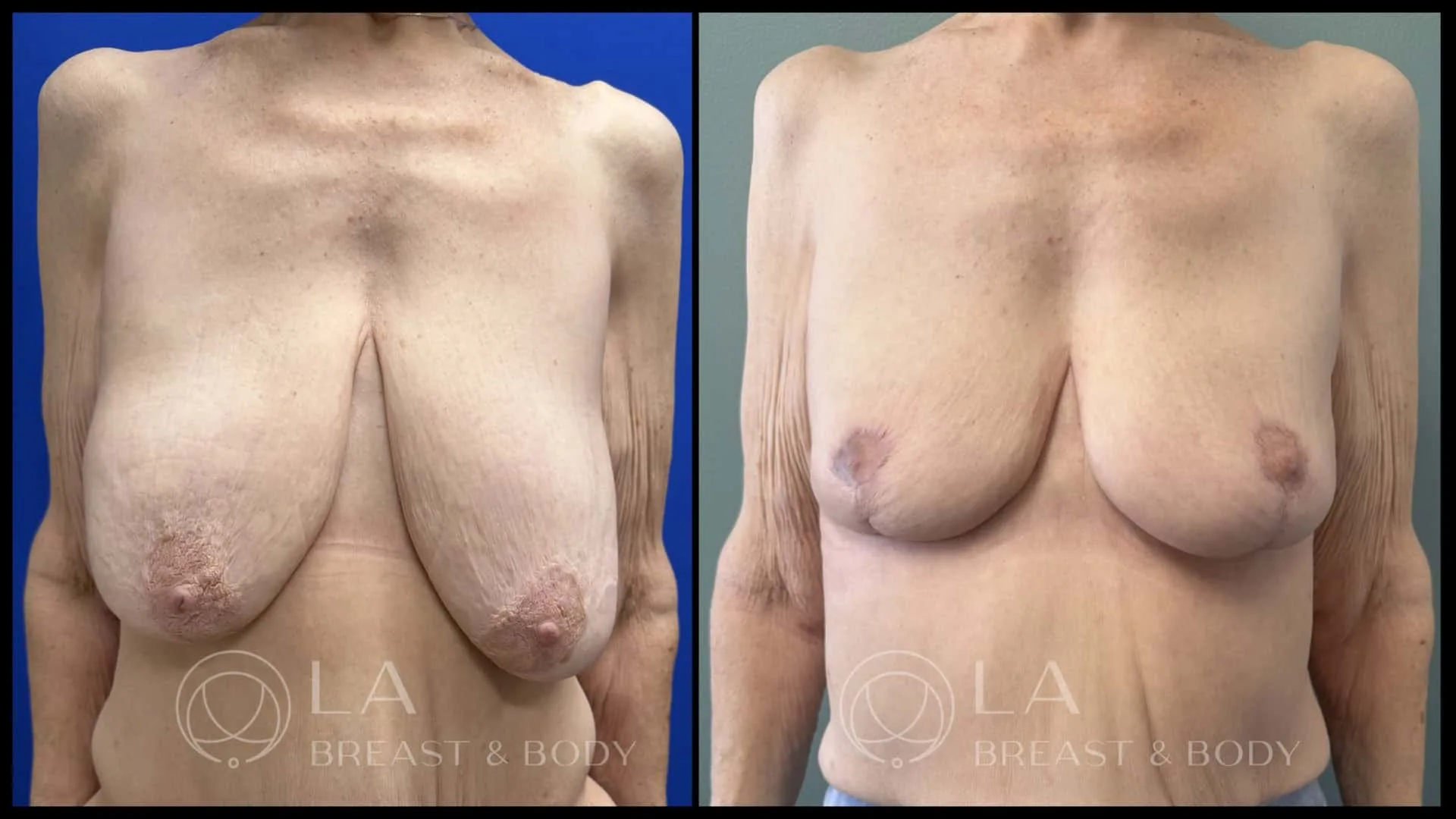 Breast lift with auto-augmentation — before and after, front view