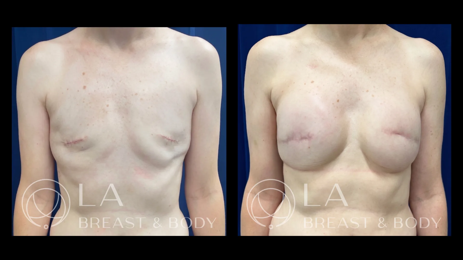Delayed implant reconstruction — before and after