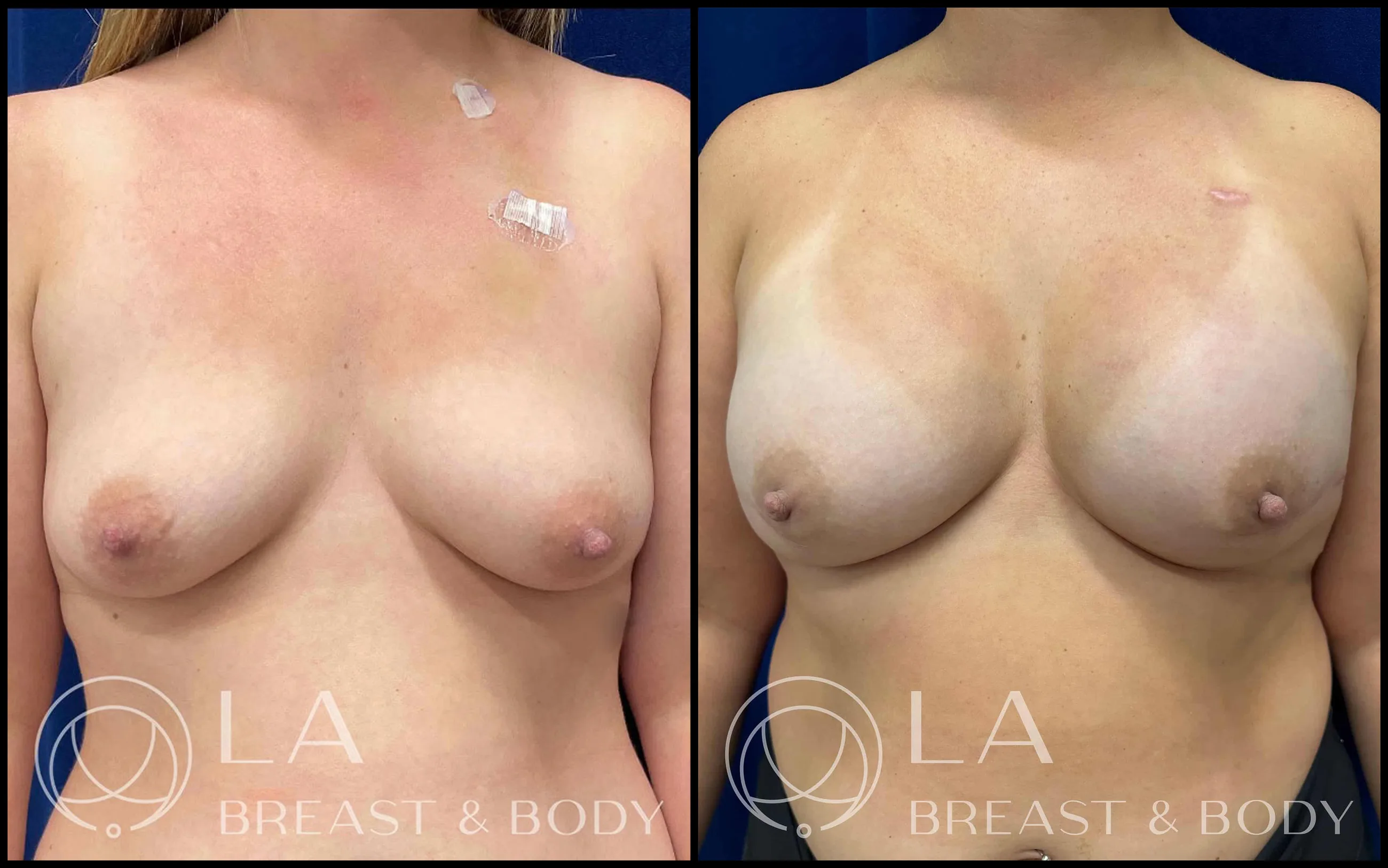 Direct-to-implant reconstruction — before and after