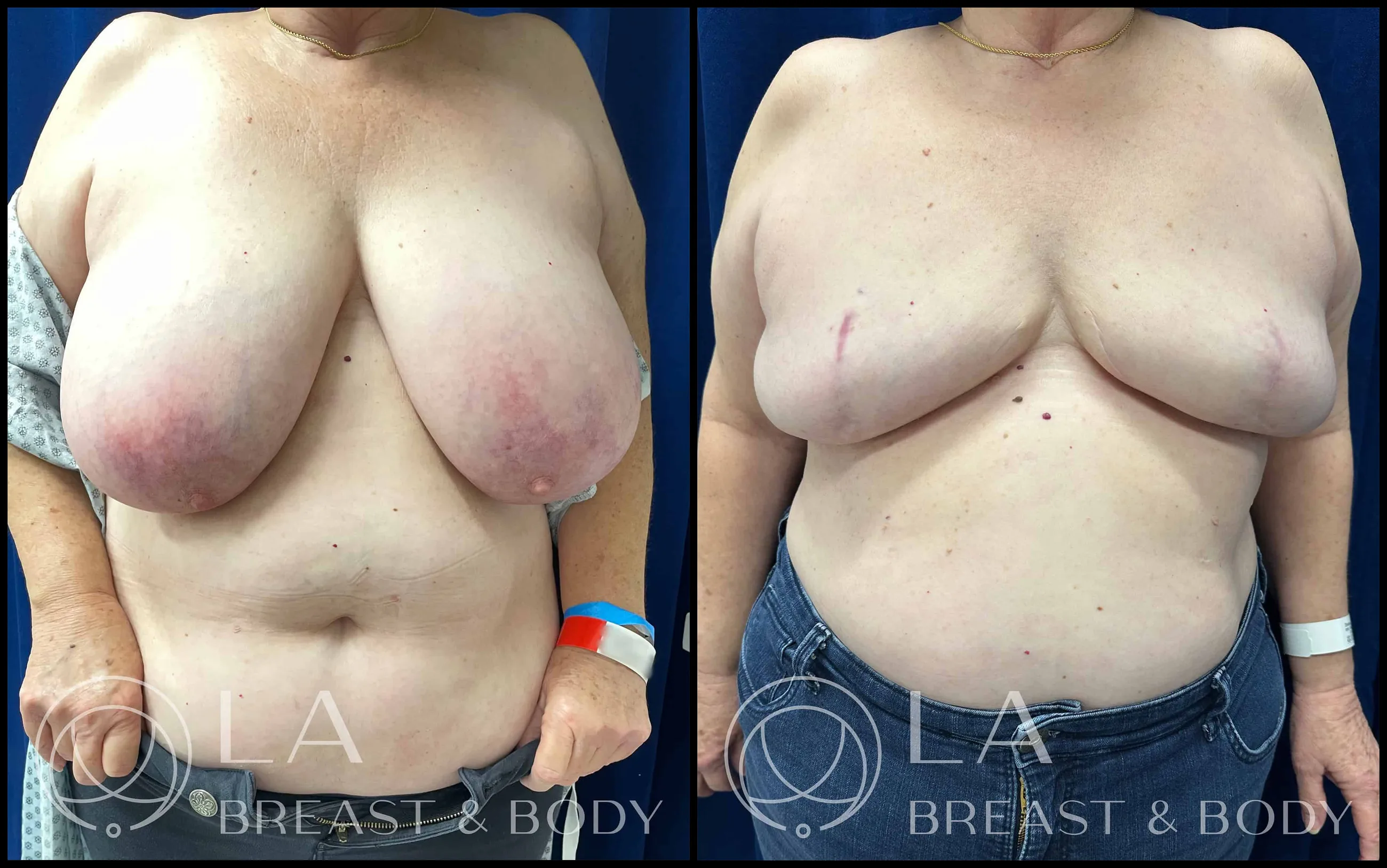 Goldilocks procedure — before and after