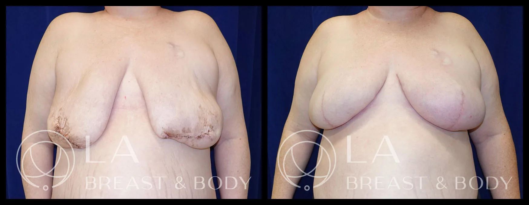 Goldilocks procedure — before and after