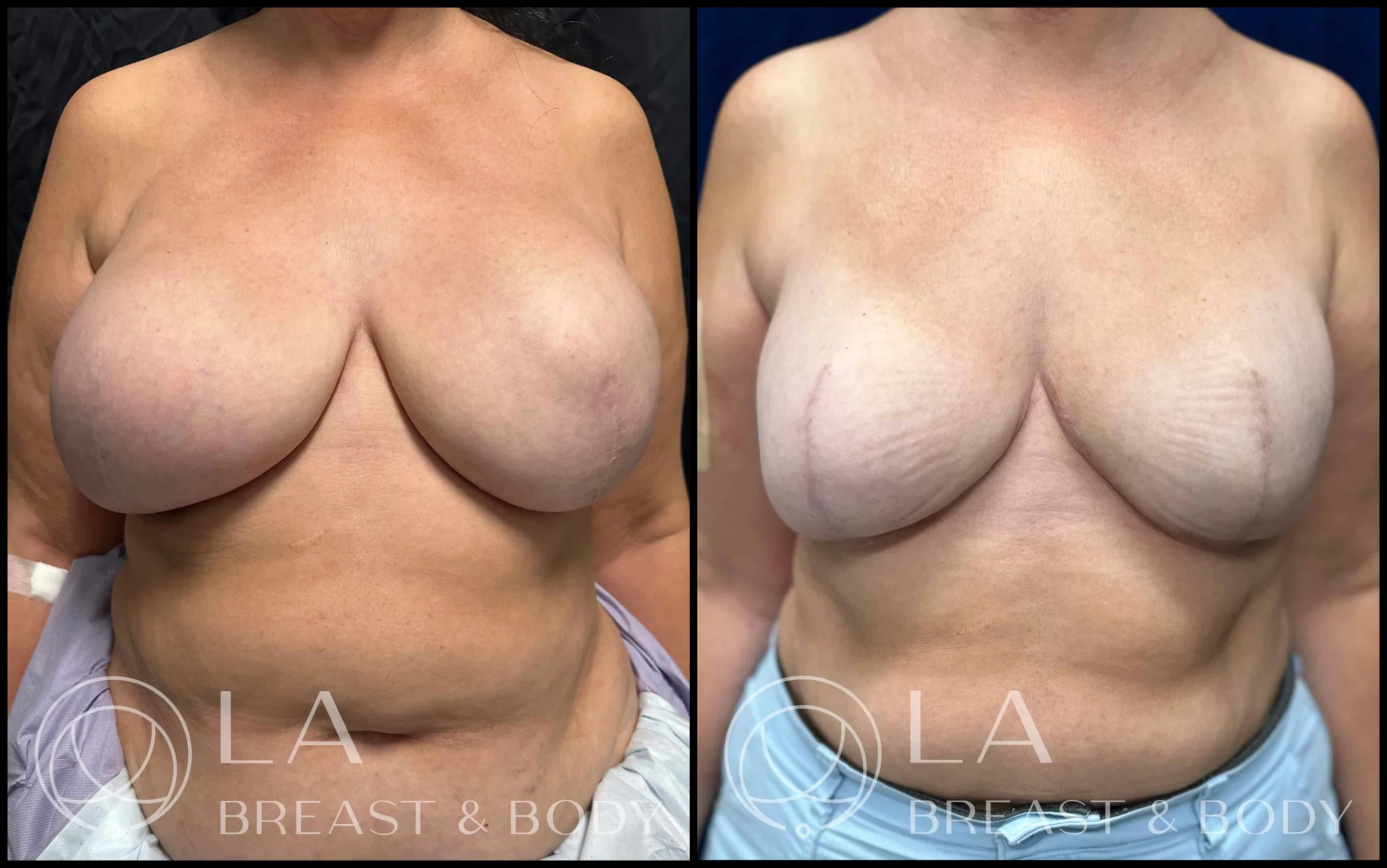 Implant downsize — before and after