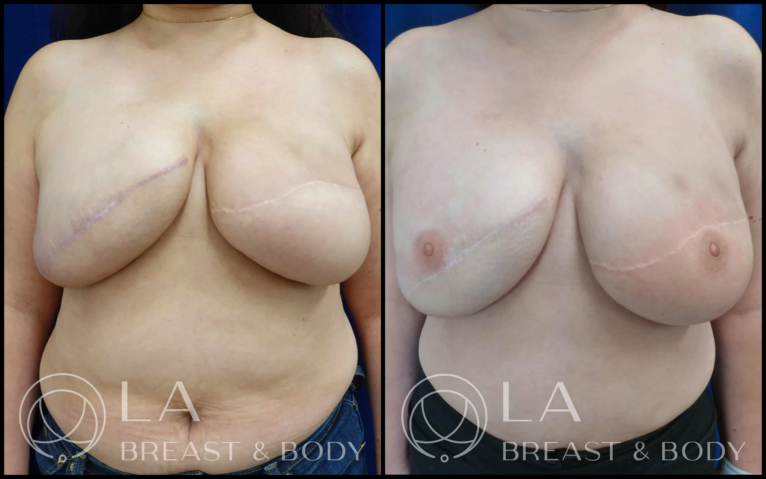 Nipple reconstruction — before and after, with 3D nipple-areola tattoo