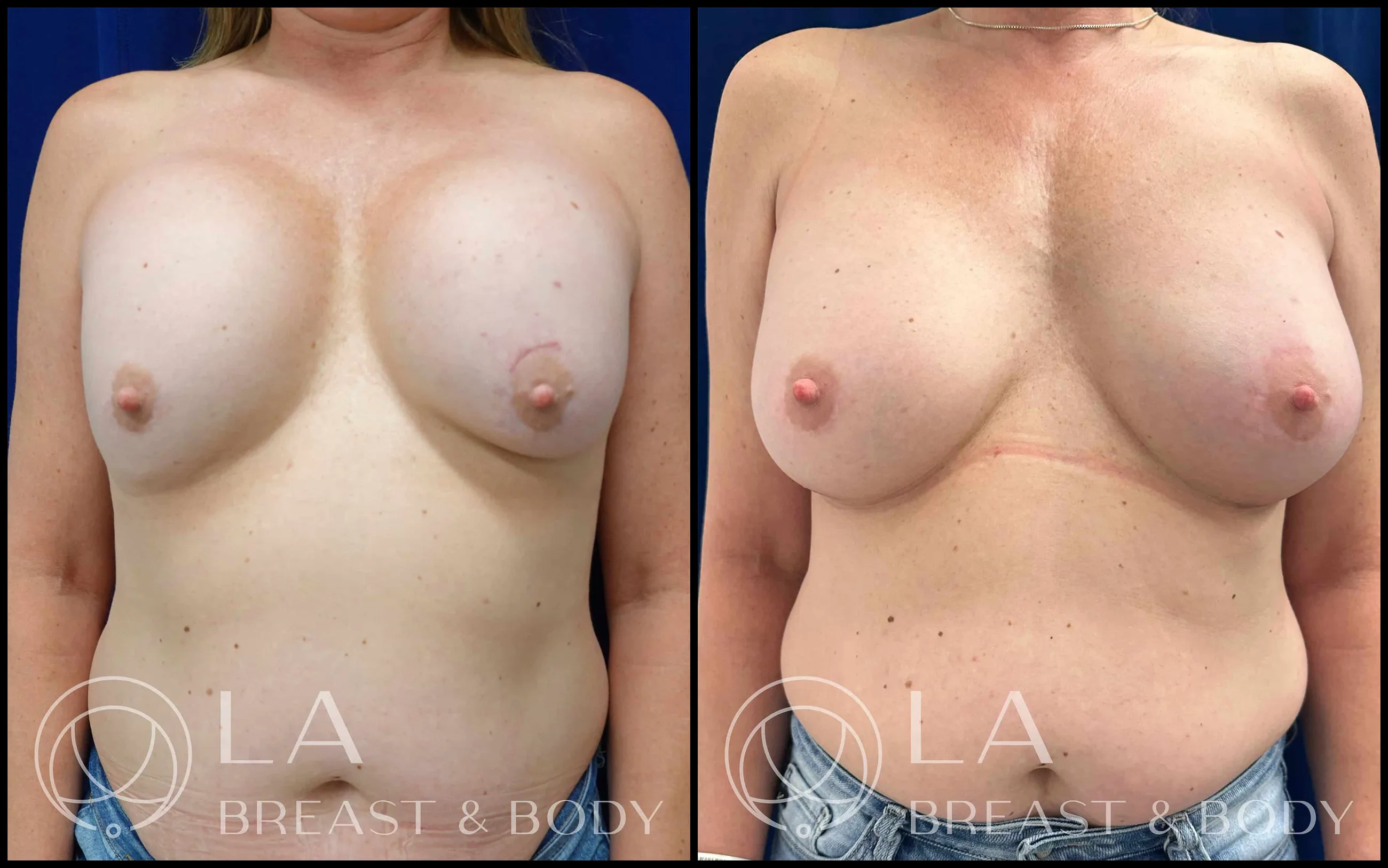 Ruptured implant revision — before and after