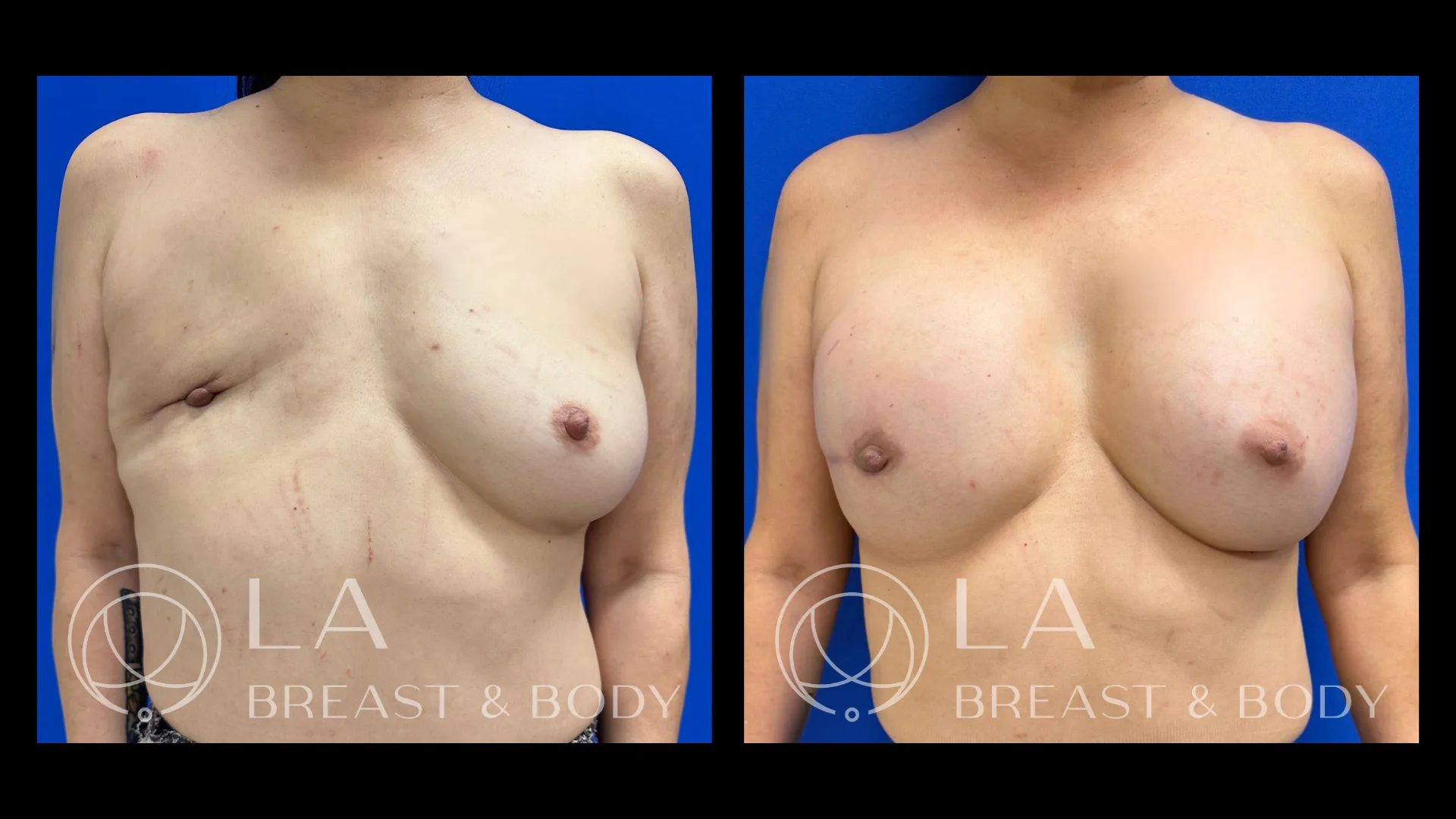 Tissue expander reconstruction — before and after, front view
