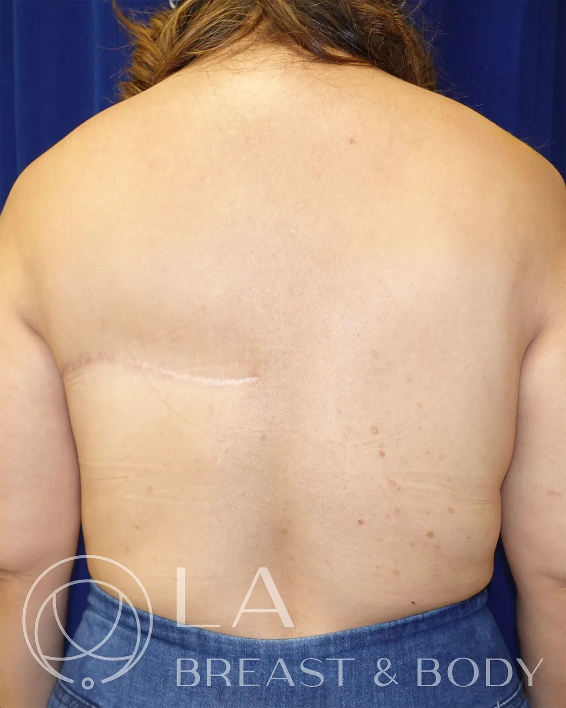 Healed bra-line scar, oriented horizontally along the bra line