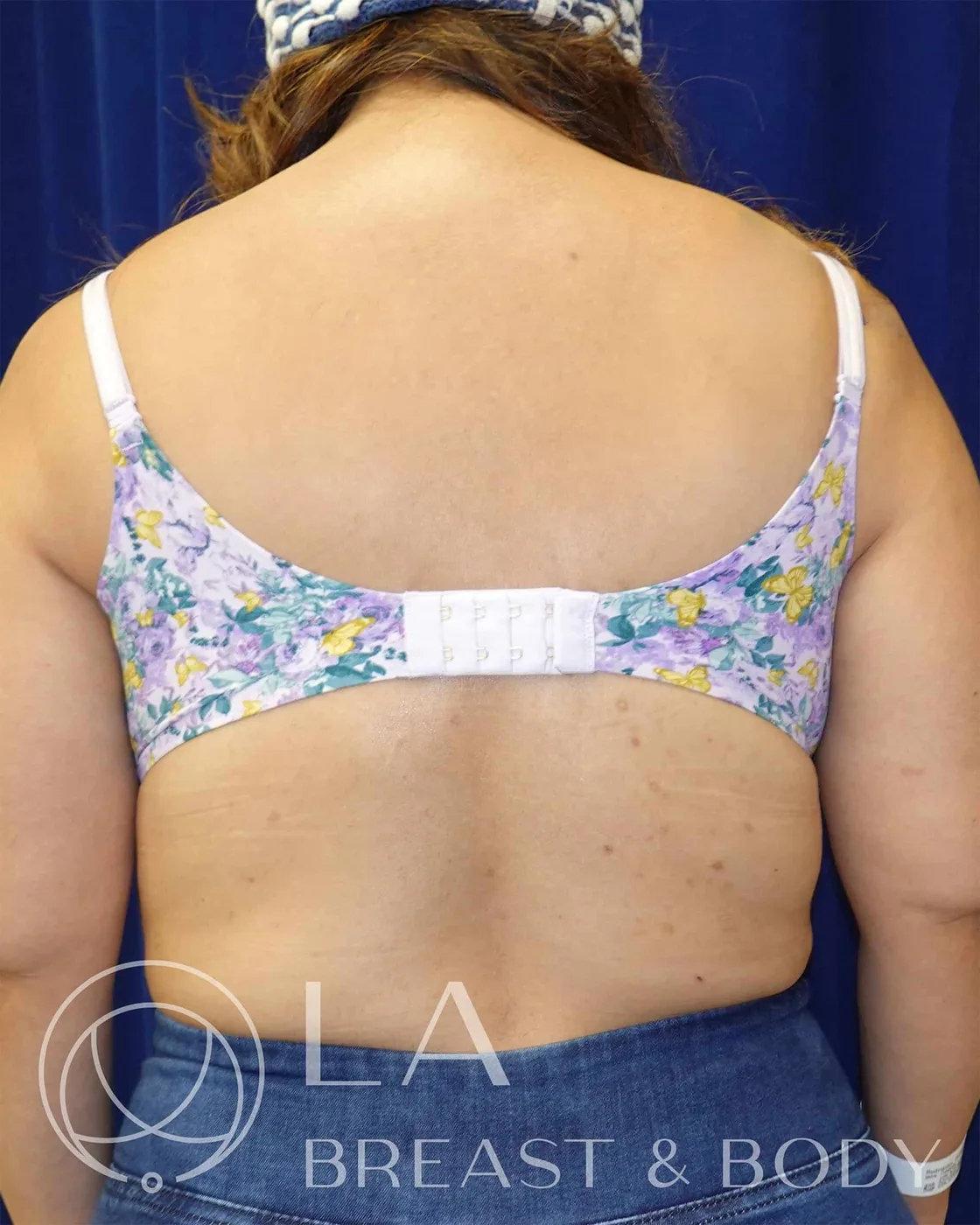 Bra-line scar concealed under a bra