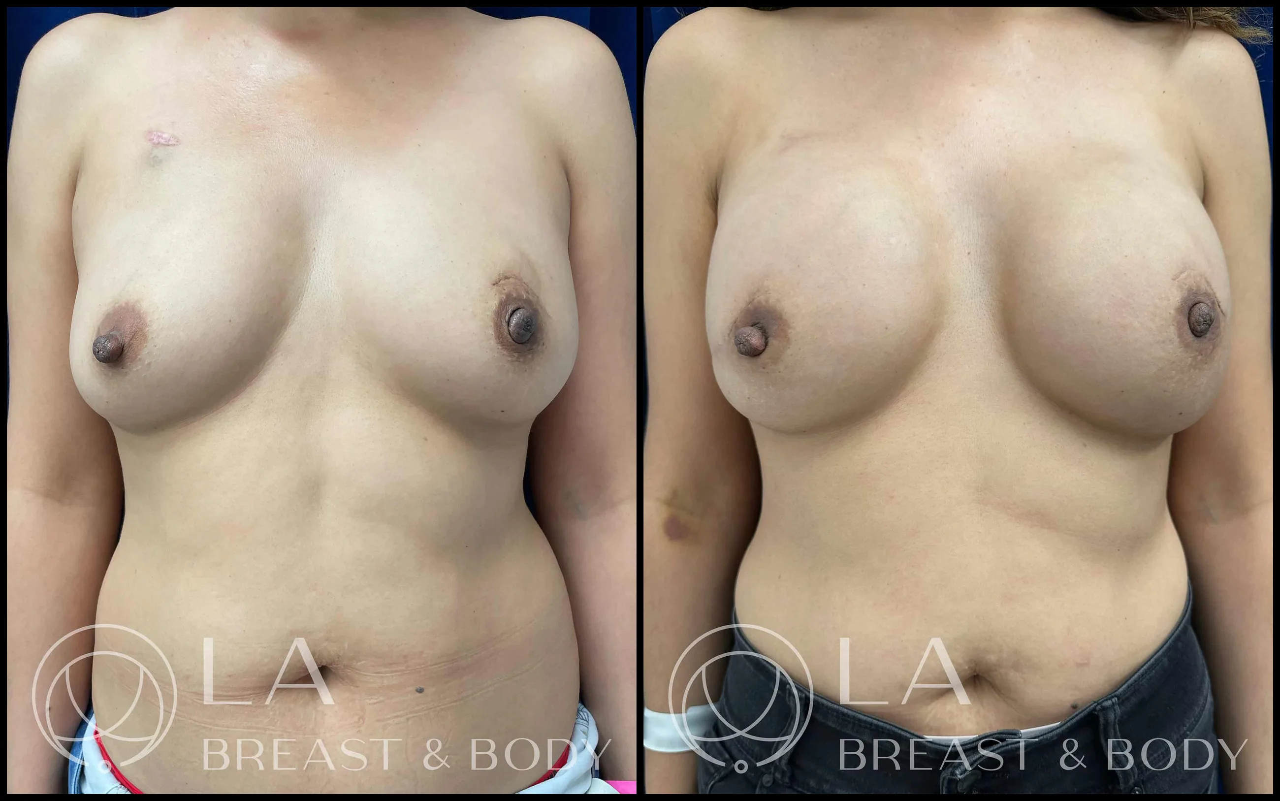 Direct-to-Implant Reconstruction before and after