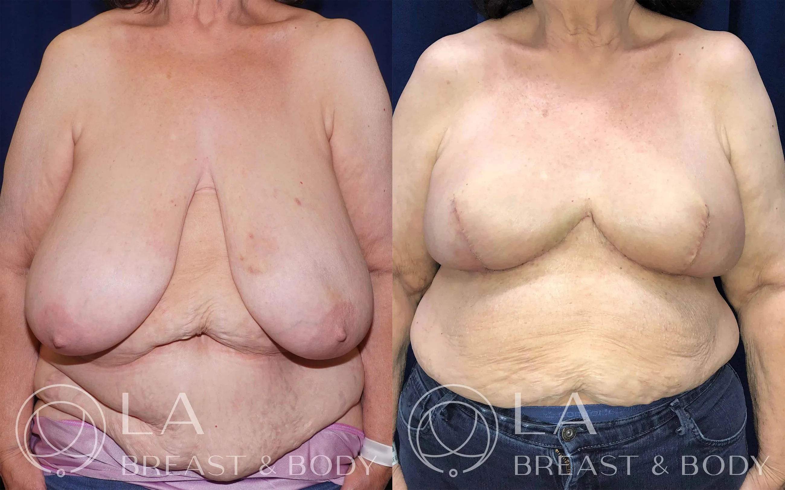 Goldilocks Procedure before and after