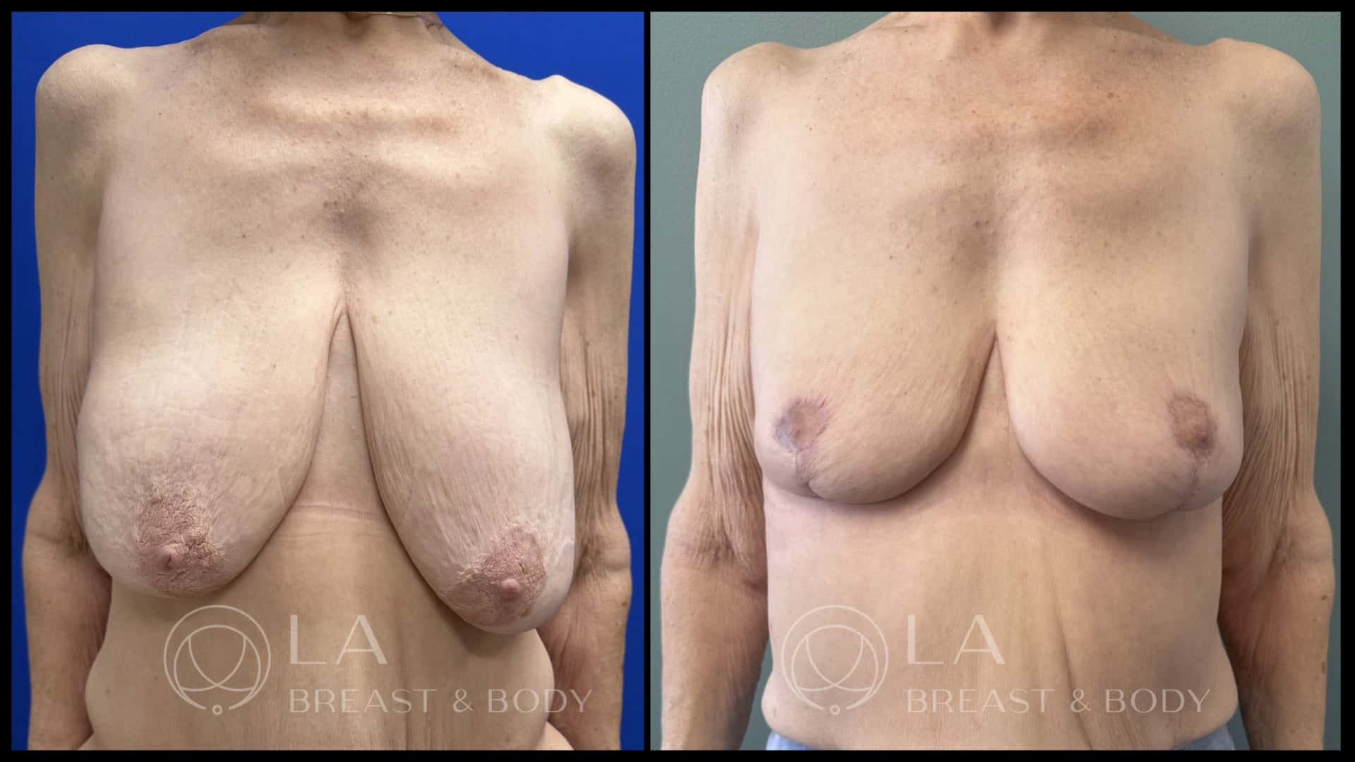 Breast Lift Before and After - Front View