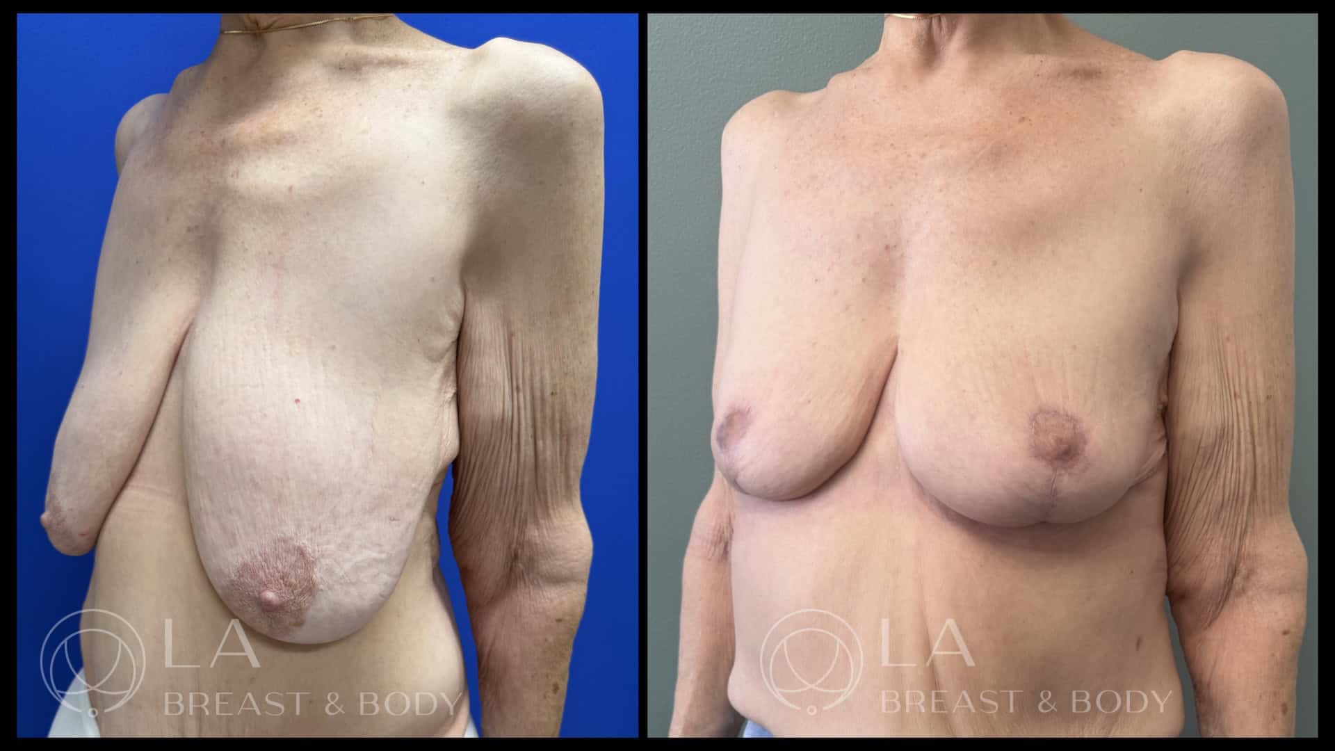 Breast Lift Before and After - Oblique Left View