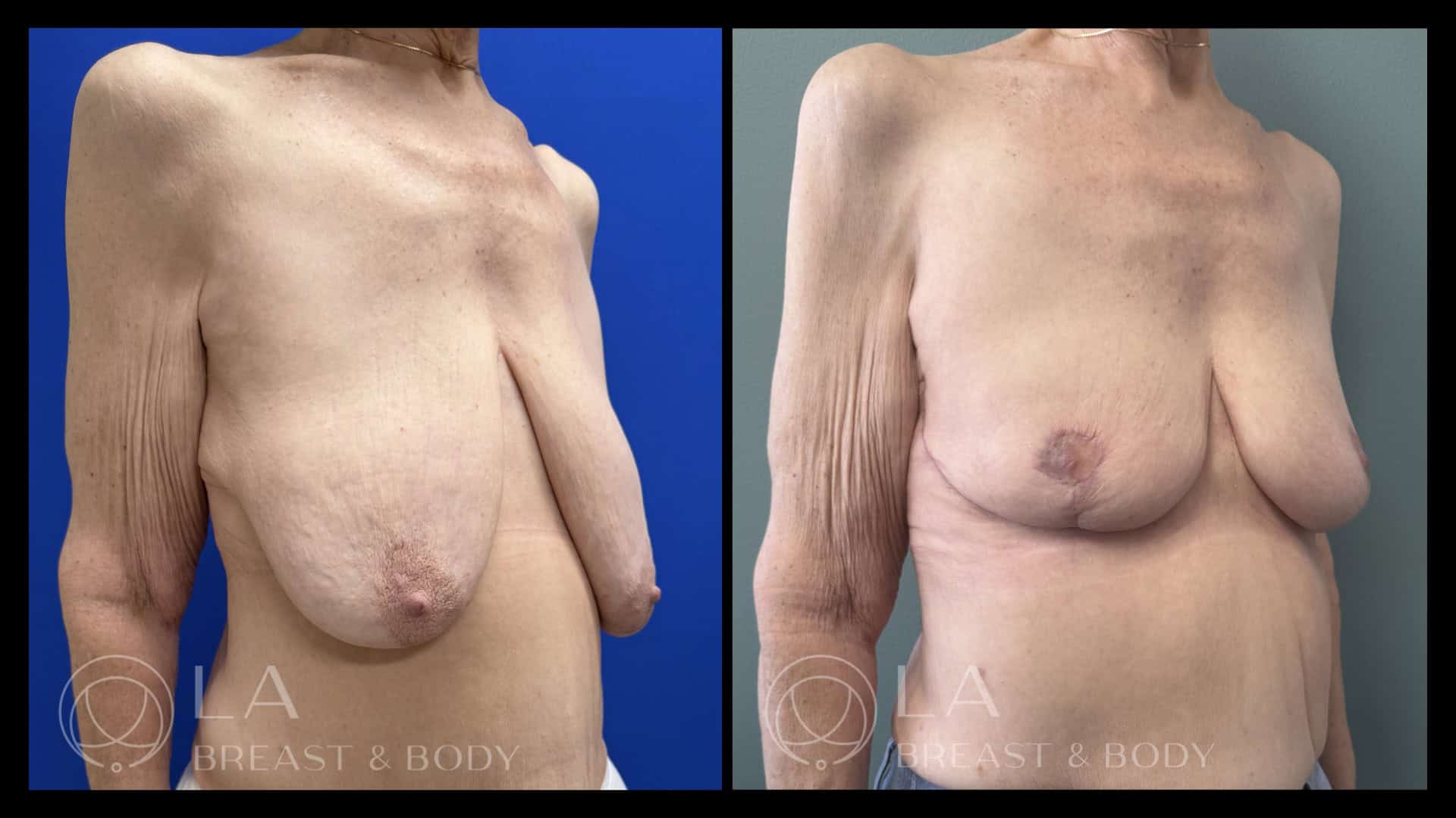Breast Lift Before and After - Side View