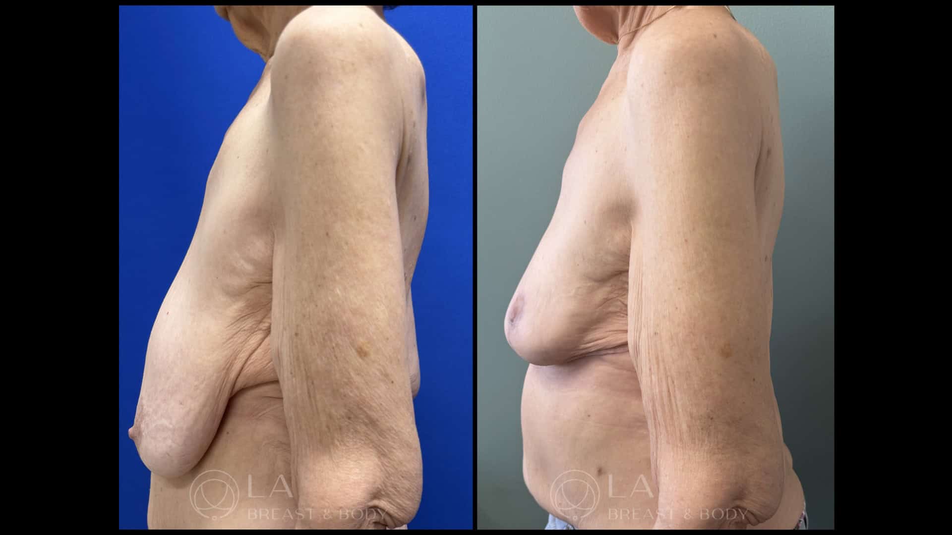 Breast Lift Before and After - Oblique Right View
