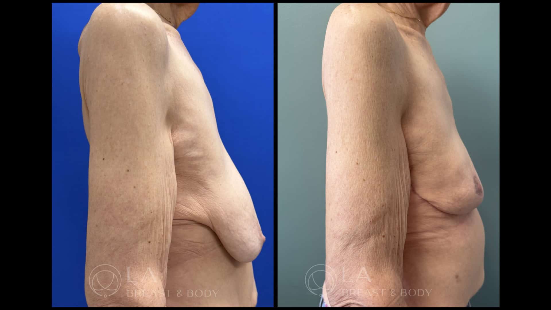 Breast Lift Before and After - Right Side View