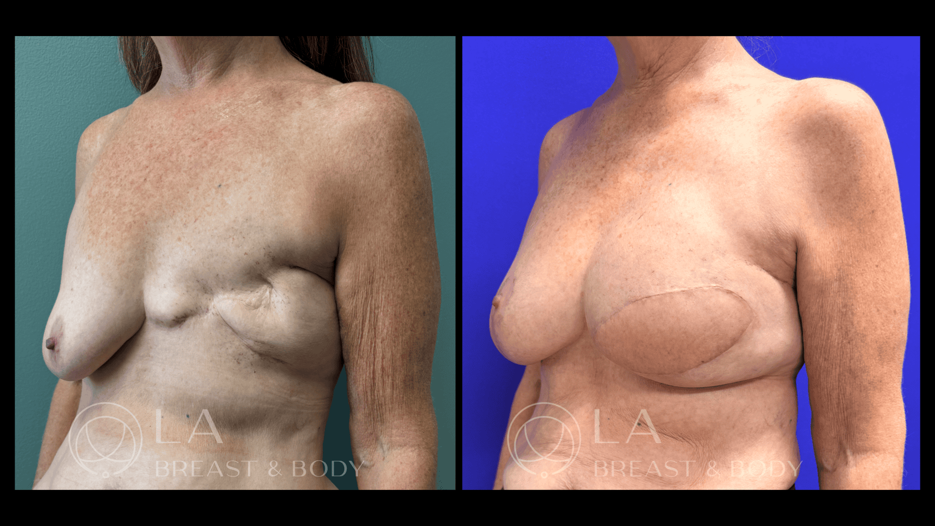 Breast Reconstruction Before and After 2
