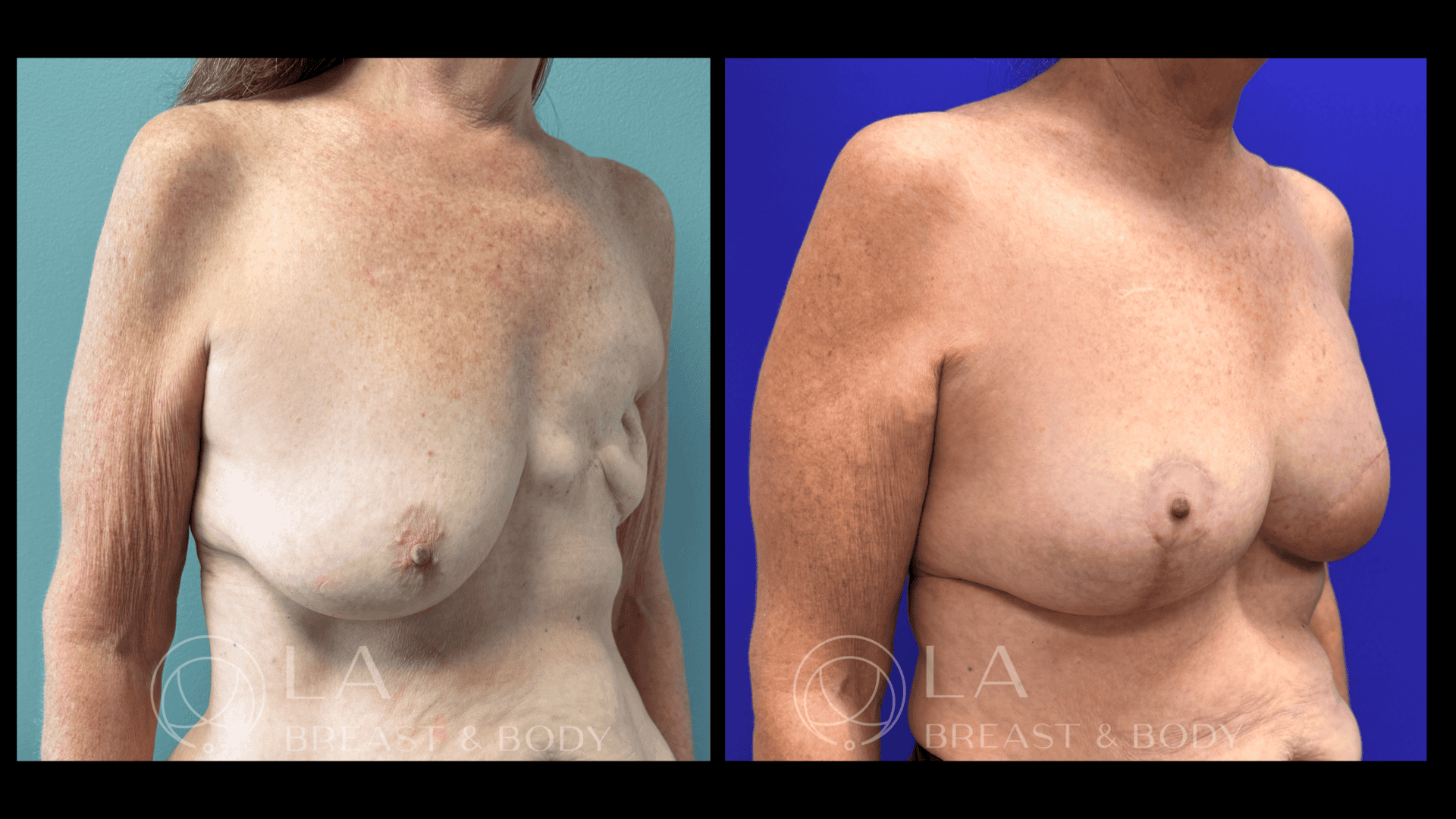 Breast Reconstruction Before and After 3