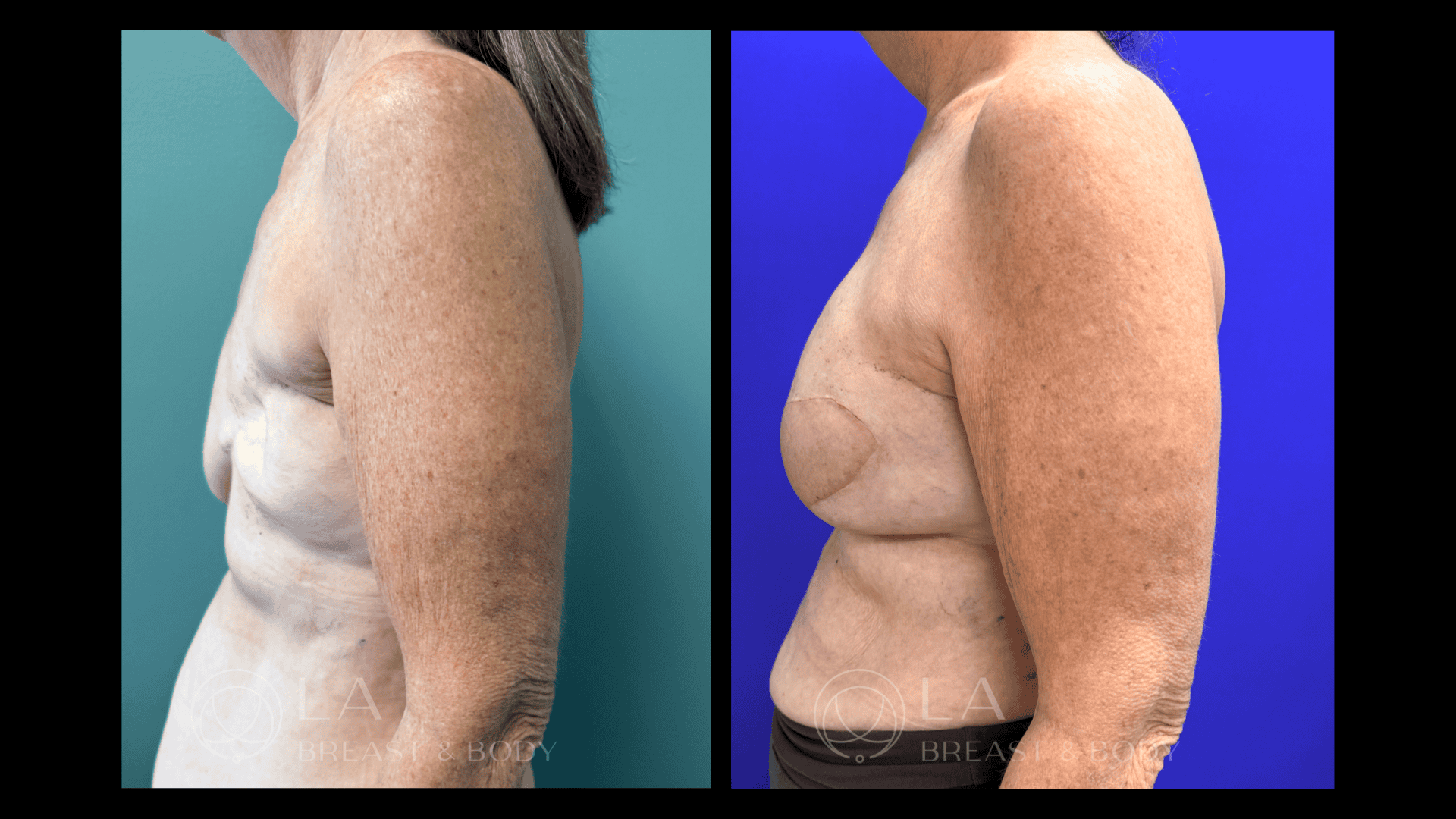 Breast Reconstruction Before and After 4