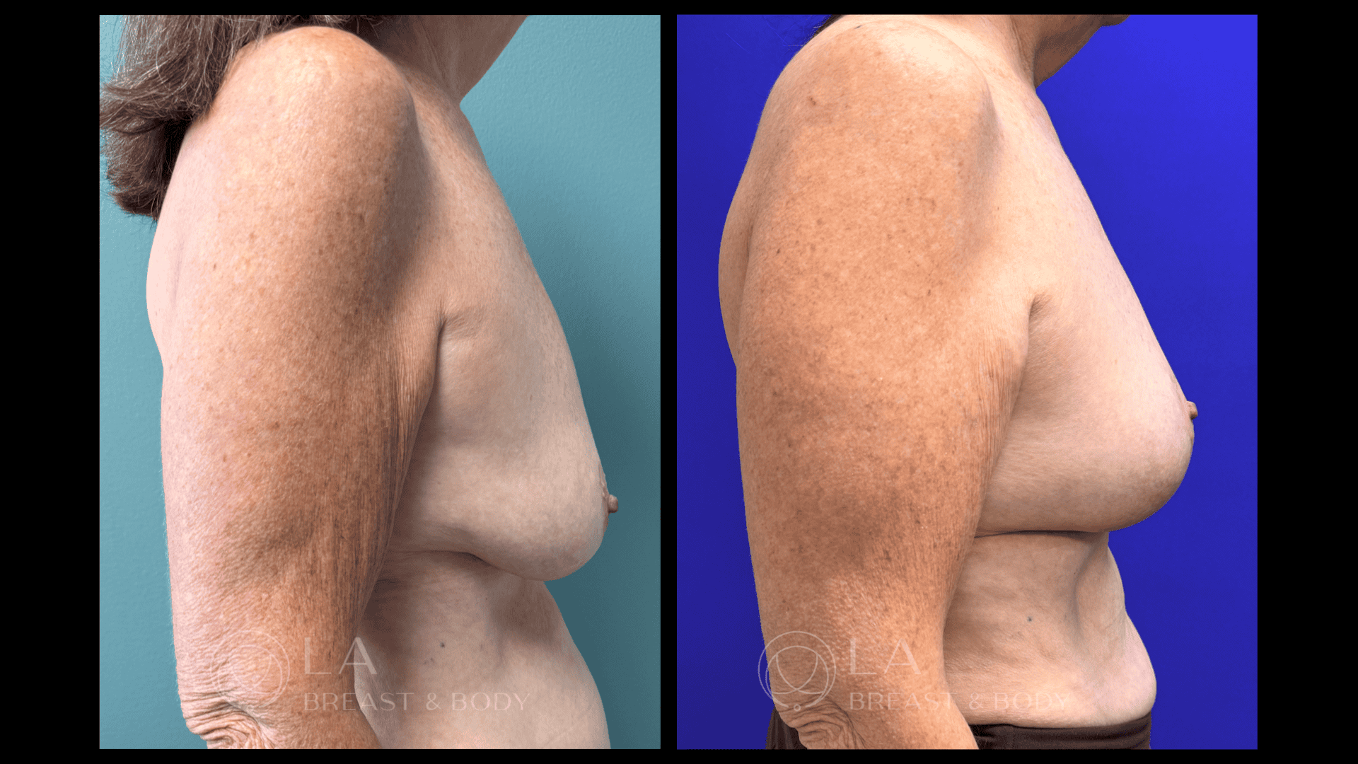 Breast Reconstruction Before and After 5