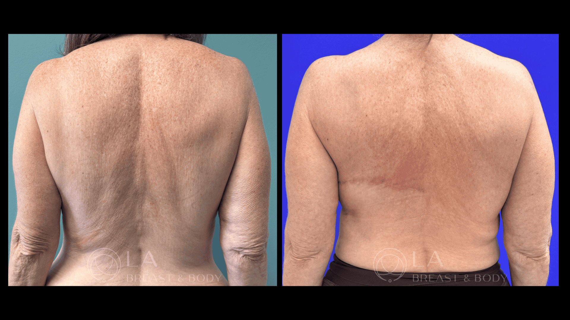 Breast Reconstruction Before and After 6