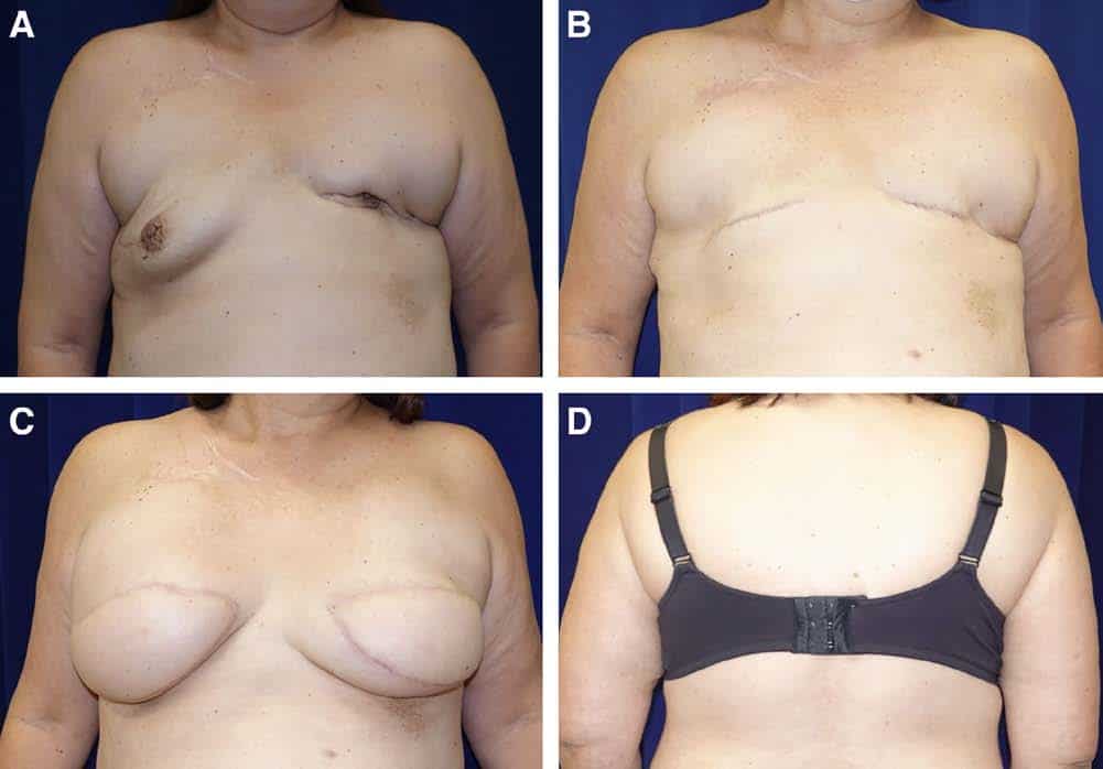 Aesthetic flat closure surgical figure 1 — LA Breast & Body