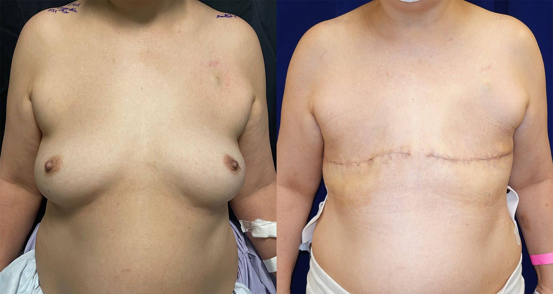 Aesthetic flat closure surgical figure 2 — LA Breast & Body