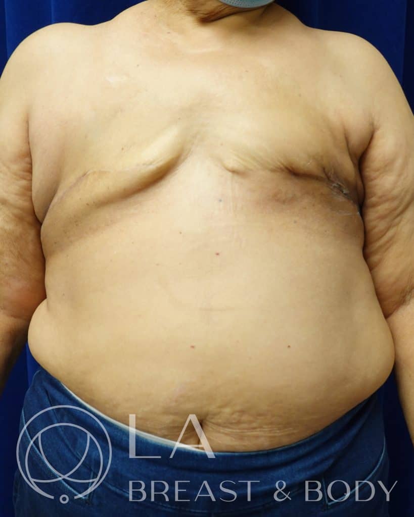 Aesthetic flat closure after mastectomy, patient 1 — LA Breast & Body