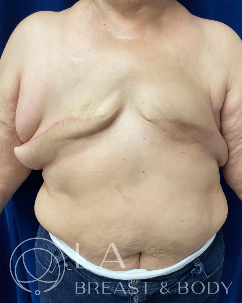 Aesthetic flat closure before mastectomy, patient 1 — LA Breast & Body