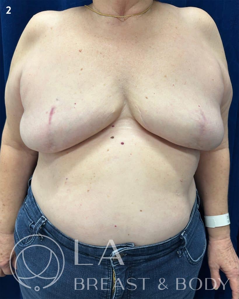 Goldilocks mastectomy procedure after, patient 1 — LA Breast & Body