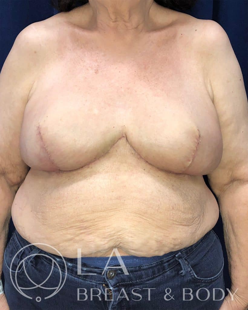 Goldilocks mastectomy procedure after, patient 2 — LA Breast & Body