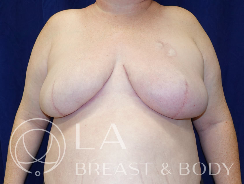 Goldilocks mastectomy procedure after, patient 3 — LA Breast & Body