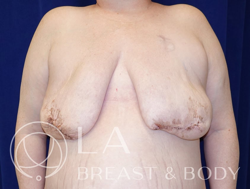 Goldilocks mastectomy procedure before, patient 3 — LA Breast & Body