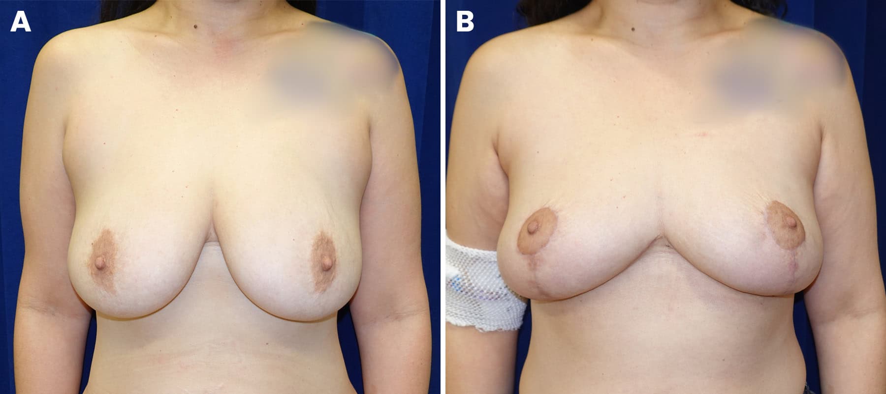 Breast reconstruction surgical figure 13 — LA Breast & Body