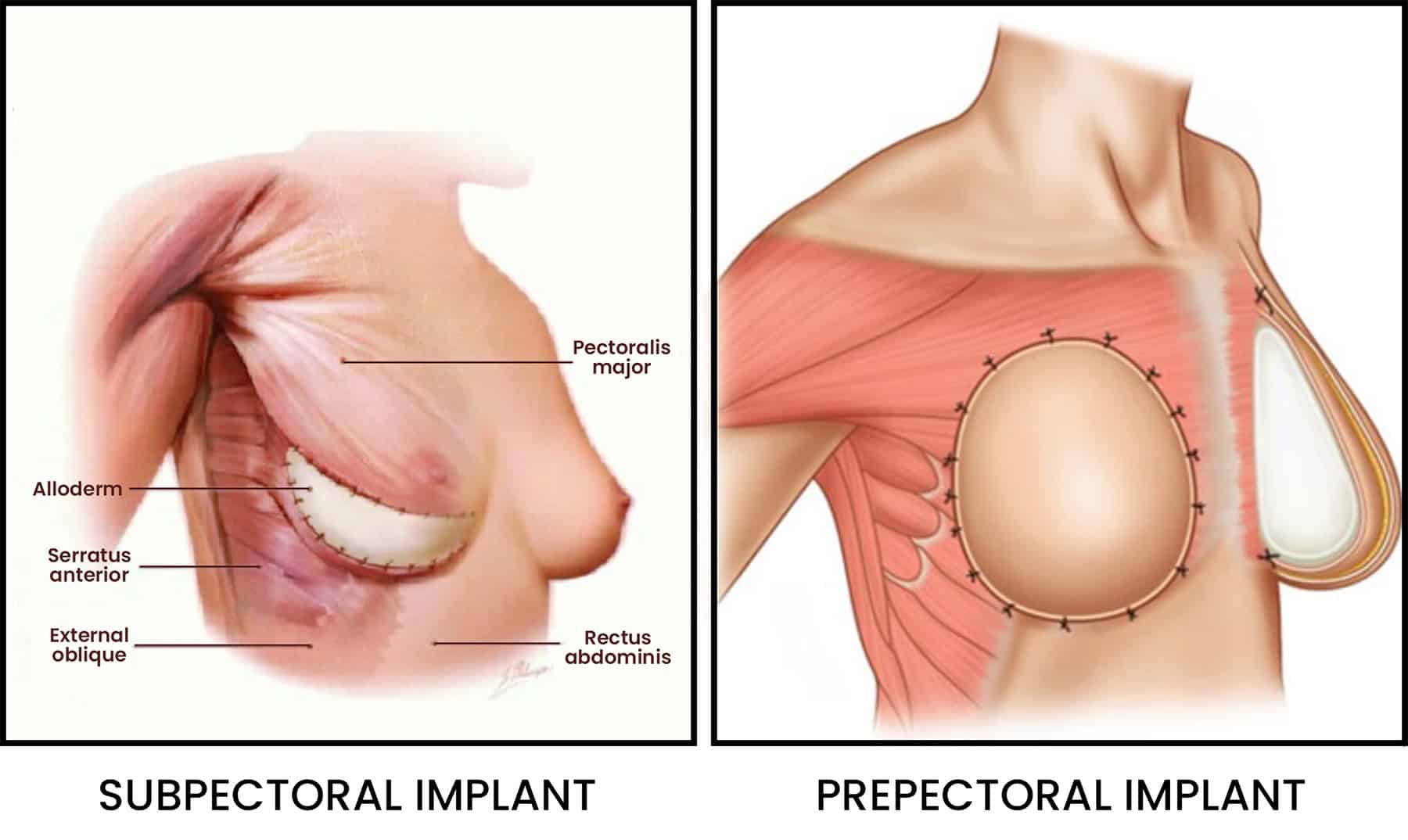 Breast reconstruction surgical figure 3 — LA Breast & Body