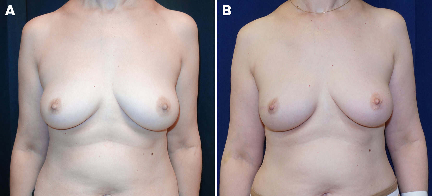 Breast reconstruction figure 3b, subpectoral implant placement — LA Breast & Body