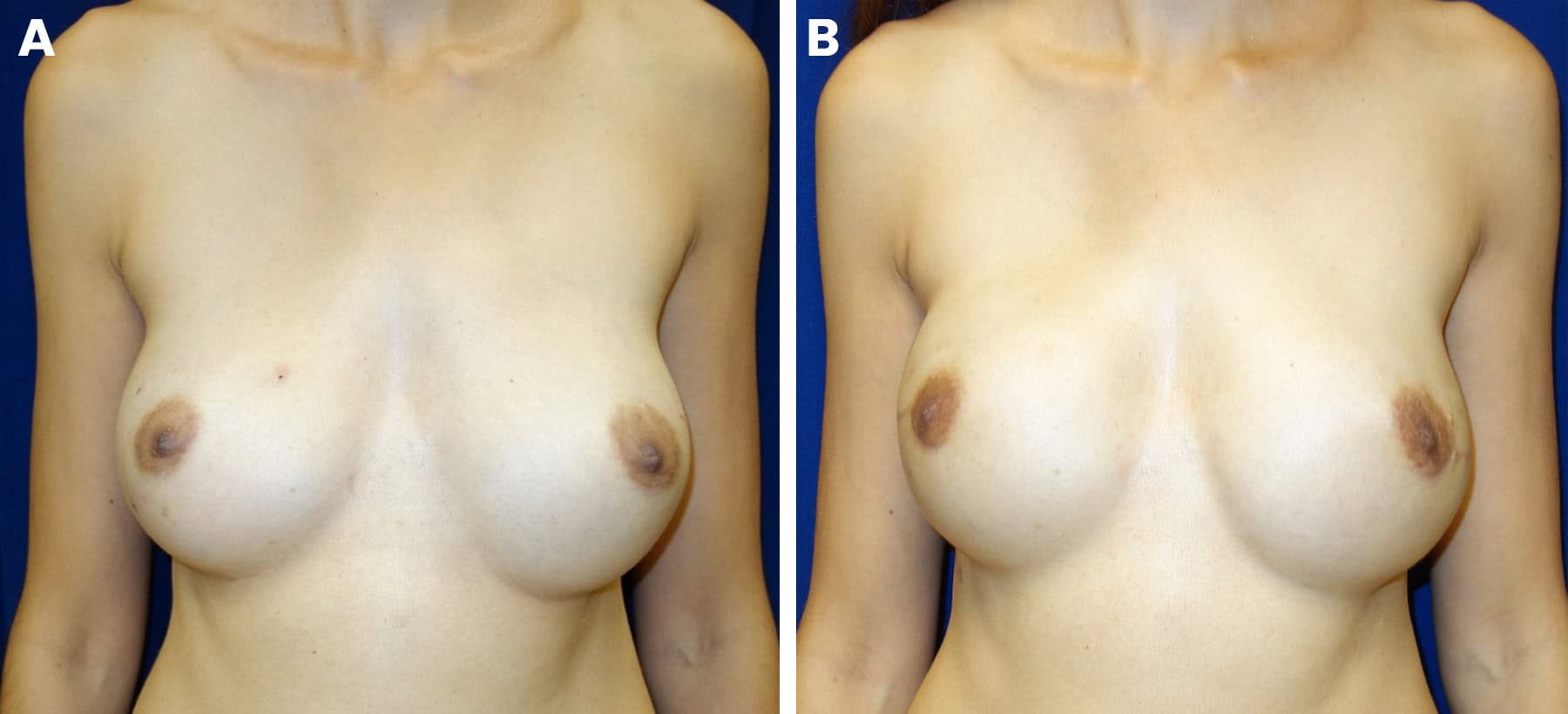 Breast reconstruction figure 4a, double mastectomy with implants — LA Breast & Body