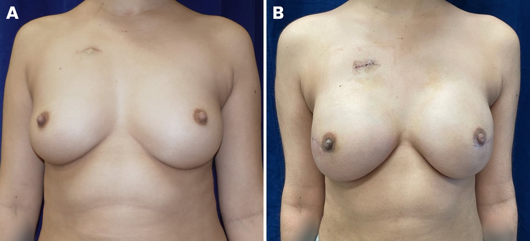 Breast reconstruction figure 5b, prepectoral implant placement — LA Breast & Body
