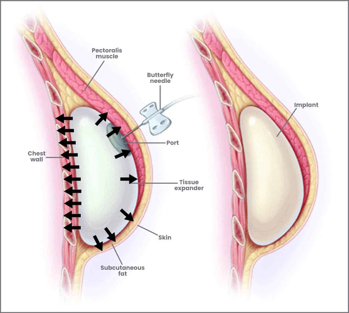 Breast reconstruction slide, tissue expander — LA Breast & Body