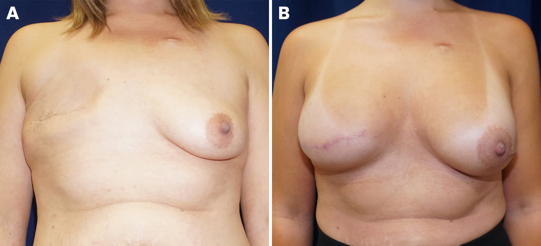 Breast reconstruction slide 5 — LA Breast & Body
