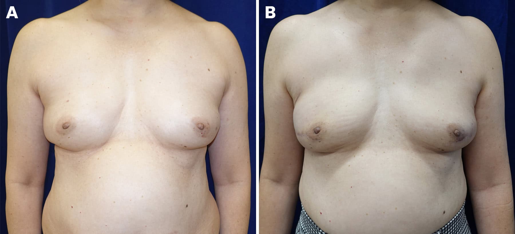 Breast reconstruction slide 6 — LA Breast & Body