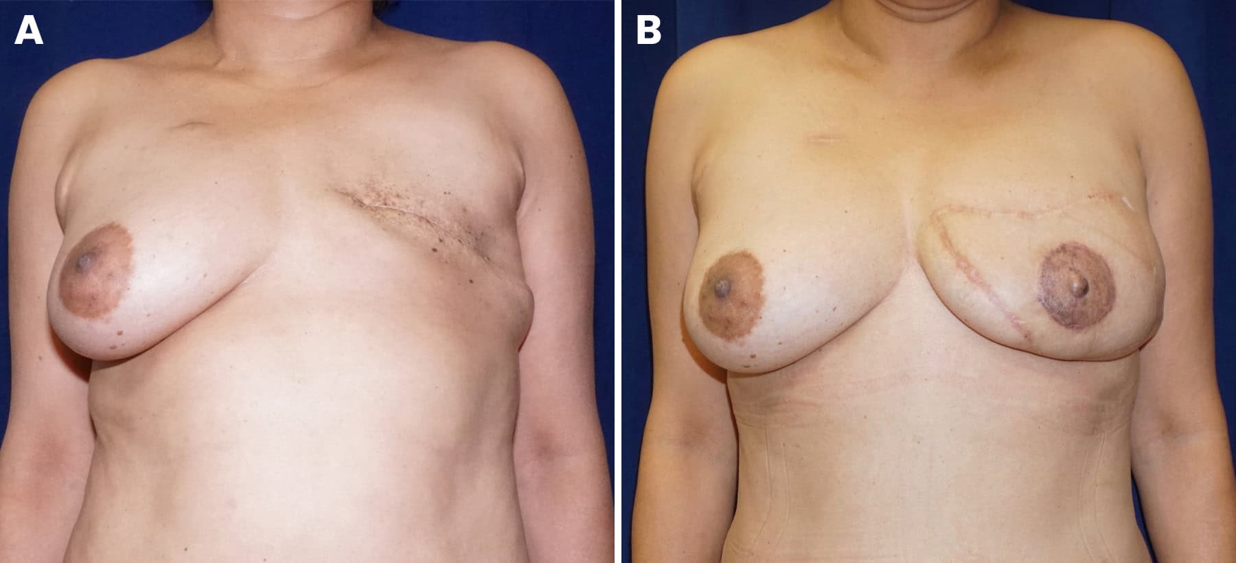 Breast reconstruction slide 7 — LA Breast & Body