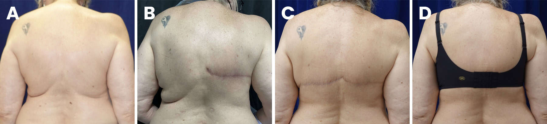 Breast reconstruction slide 8 — LA Breast & Body