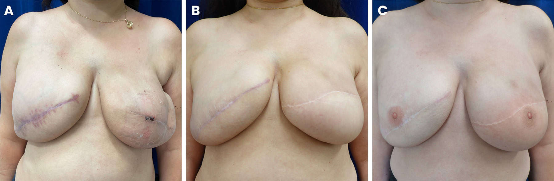 3D nipple areola tattoo on LAT flap reconstruction, figure 6 — LA Breast & Body