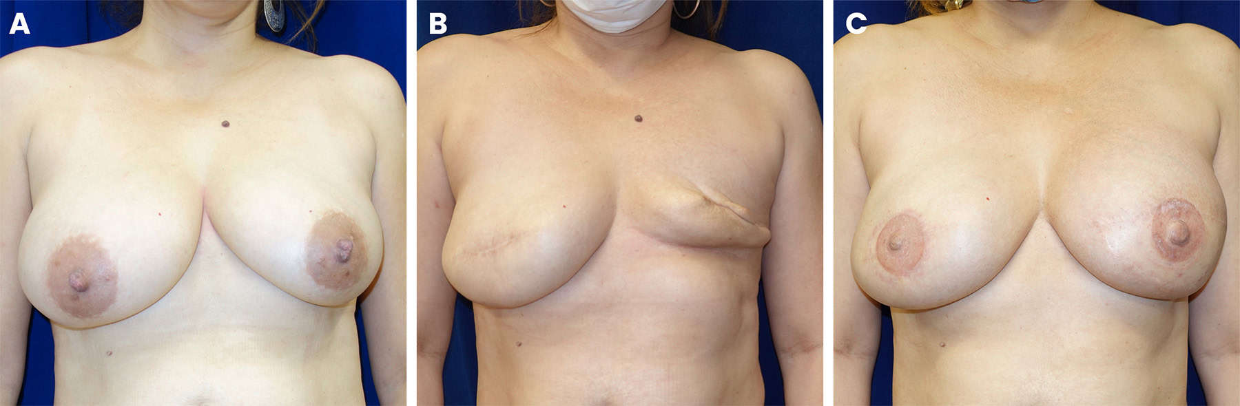 3D nipple areola tattoo, figure 3 — LA Breast & Body