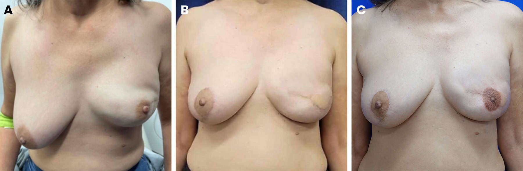 3D nipple areola tattoo, figure 7 — LA Breast & Body