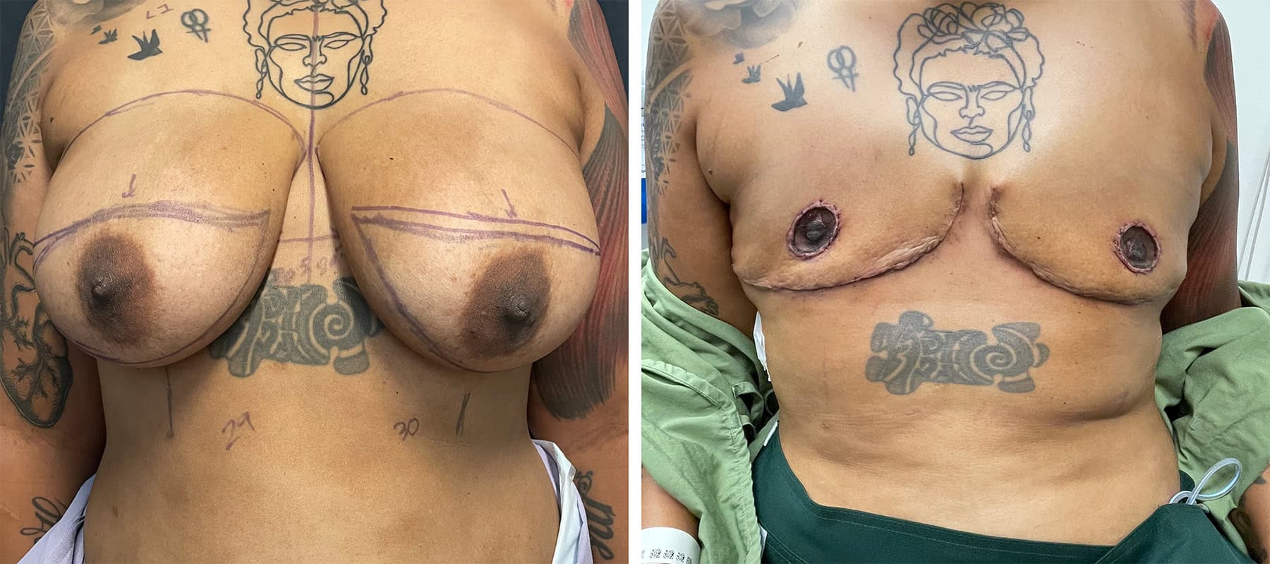 Nipple areola reconstruction surgical figure 5 — LA Breast & Body